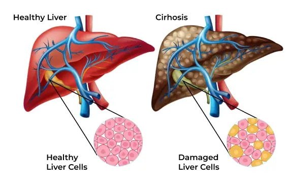 Child pugh calculator For (Liver Cirrhosis) Mortality